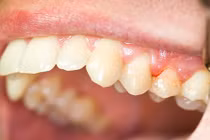 Giáo viên dạy tiếng Anh suýt mất mạng vì chảy máu chân răng