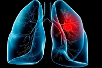 Nguyên nhân nào khiến ung thư đang trở thành đại dịch?