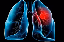 Nguyên nhân nào khiến ung thư đang trở thành đại dịch?