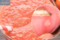 Cách chữa nhiệt miệng hiệu quả tại nhà