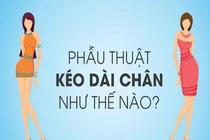 Video: Phẫu thuật kéo dài chân như thế nào?