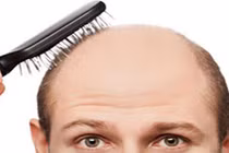 Hói đầu liệu có di truyền không?