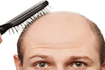 Hói đầu liệu có di truyền không?