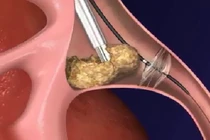 Xem cách bác sĩ lấy sỏi thận ra khỏi cơ thể người