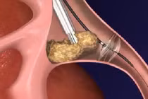 Xem cách bác sĩ lấy sỏi thận ra khỏi cơ thể người