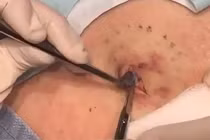 Sốc với ca lấy mụn đầu đen khổng lồ nhất từ trước đến nay