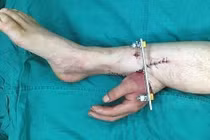 Nổi da gà xem bàn tay mọc từ bắp chân ở Trung Quốc