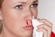 Những căn bệnh nguy hiểm tiềm ẩn đằng sau chứng chảy máu cam