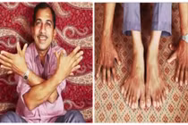 Clip người đàn ông có nhiều ngón tay chân nhất thế giới