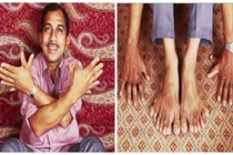 Clip người đàn ông có nhiều ngón tay chân nhất thế giới