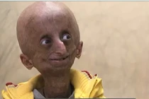 Sửng sốt cậu bé 15 tuổi mang hình hài như ông cụ 90