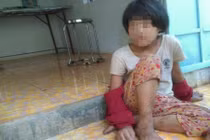 Cuộc sống đáng thương của bé gái từng bị mẹ cắt gân chân