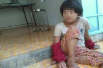 Cuộc sống đáng thương của bé gái từng bị mẹ cắt gân chân