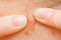 Bệnh nhân U60 tự nặn mụn... nhiễm trùng, nguy kịch tính mạng