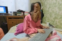 Bệnh lạ biến người phụ nữ Hàn Quốc thành quái vật