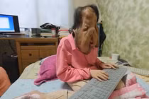 Bệnh lạ biến người phụ nữ Hàn Quốc thành quái vật