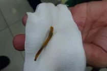 Thanh niên ăn thịt ếch bị xương đâm thủng ruột mà không biết