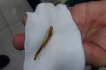 Thanh niên ăn thịt ếch bị xương đâm thủng ruột mà không biết