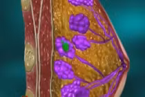 Cách nhận biết sớm ung thư vú