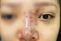 Nữ sinh mù mắt khi tiêm filler: Tiết lộ từ bác sĩ 