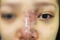 Nữ sinh mù mắt khi tiêm filler: Tiết lộ từ bác sĩ 