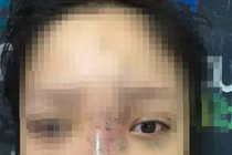 Nữ sinh bị mù mắt khi tiêm filler: Dấu hiệu đáng ngờ bên trong spa