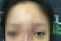 Nữ sinh bị mù mắt khi tiêm filler: Dấu hiệu đáng ngờ bên trong spa