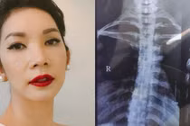 Xuân Lan tiết lộ bị cong vẹo cột sống phải nắn bẻ xương