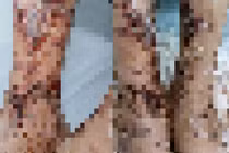 Người đàn ông viêm da nhiễm trùng nặng sau lội nước, đắp lá