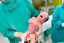 Dây rốn thắt nút, xử trí thế nào để an toàn thai nhi?