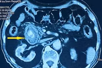 Cụ ông bị tắc ruột do chủ quan sỏi túi mật nhiều năm