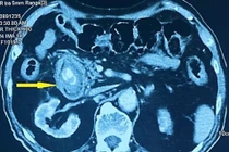 Cụ ông bị tắc ruột do chủ quan sỏi túi mật nhiều năm