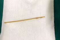 Người phụ nữ thủng ruột do thói quen ngậm tăm sau khi ăn