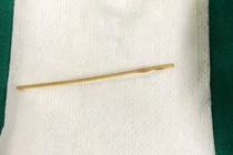 Người phụ nữ thủng ruột do thói quen ngậm tăm sau khi ăn