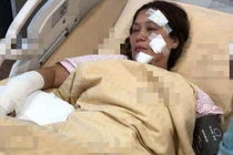 Nữ diễn viên "Anh hùng xạ điêu" bỏng nặng sau vụ cháy phim trường