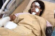 Nữ diễn viên "Anh hùng xạ điêu" bỏng nặng sau vụ cháy phim trường