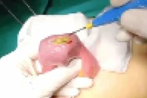 Nữ bệnh nhân tắc ruột do thói quen nhai không kỹ