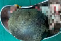 Lấy viên sỏi nặng 700g trong bàng quang người đàn ông 45 tuổi