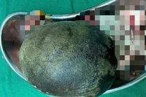 Lấy viên sỏi nặng 700g trong bàng quang người đàn ông 45 tuổi