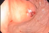 Cứu người đàn ông bị vỡ tĩnh mạch dạ dày nguy kịch