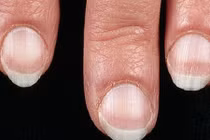 Dấu hiệu bệnh nguy hiểm thể hiện qua móng tay