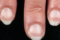 Dấu hiệu bệnh nguy hiểm thể hiện qua móng tay