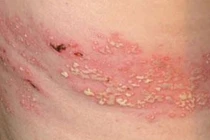 Biến chứng đáng sợ của bệnh zona thần kinh