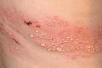 Biến chứng đáng sợ của bệnh zona thần kinh