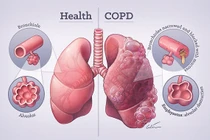 Cách đối phó với bệnh phổi tắc nghẽn hơn 380 triệu người mắc