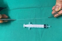 Gắp con giun dài 14 cm khỏi mắt bệnh nhân 68 tuổi