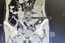 Đau bụng, nôn... đi khám phát hiện dính ruột, bệnh biến chứng nguy hiểm