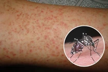 Phân biệt sốt xuất huyết và sốt thông thường