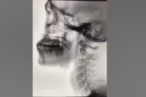 Chế độ dinh dưỡng cho người bệnh mắc chứng khó nuốt