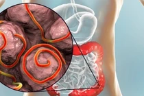 Phát hiện gần 30 con giun móc còn sống làm ổ trong dạ dày